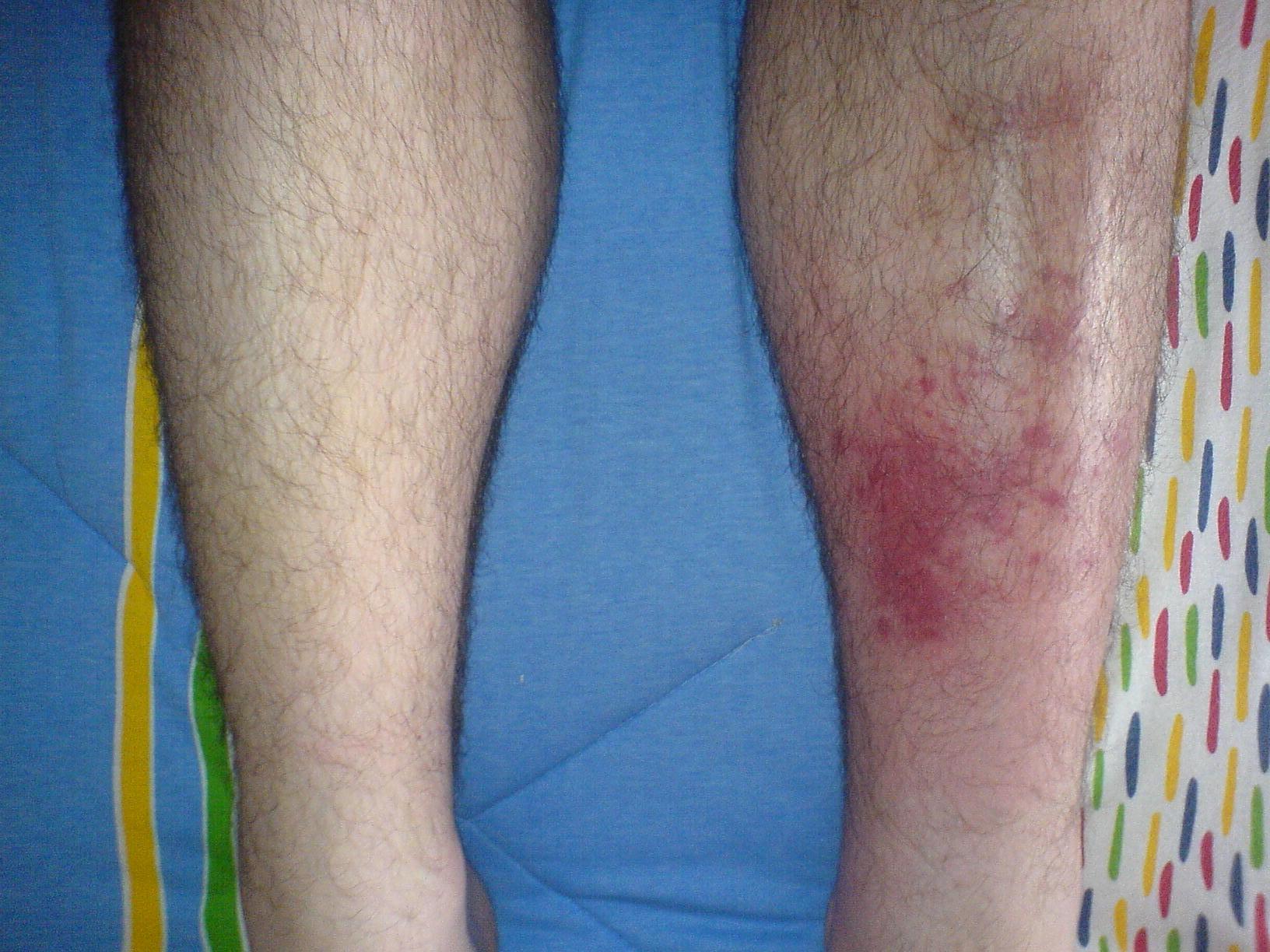 cellulitis1