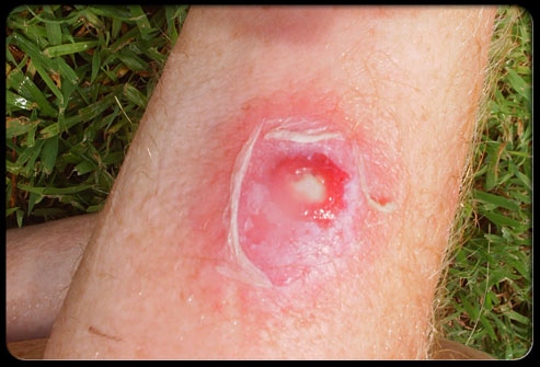 staph-infection-s4-photo-of-staph-infection